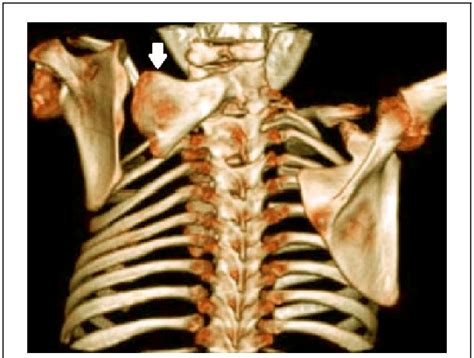 Chest Ct 3d Reconstruction Image Posterior View Showing Elevated Left