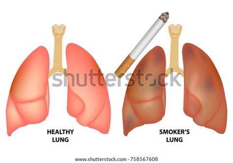 Illustration Healthy Lungs Lungs Smoker Stock Vector Royalty Free