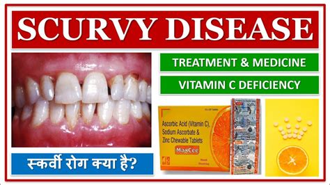 SCURVY DISEASE सकरव रग कय ह VITAMIN C DEFICIENCY SIGN