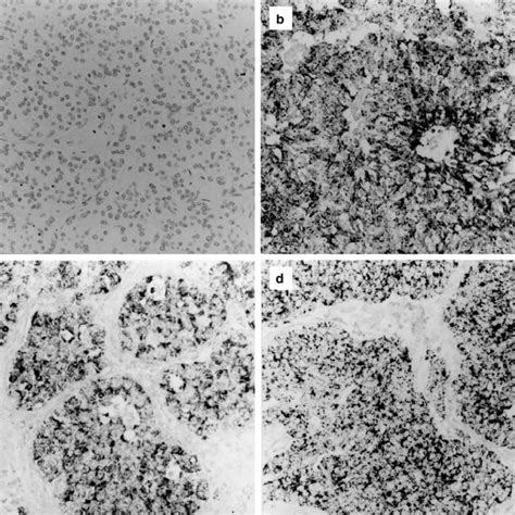 ( a ) A combined large-cell neuroendocrine carcinoma (left) and... | Download Scientific Diagram