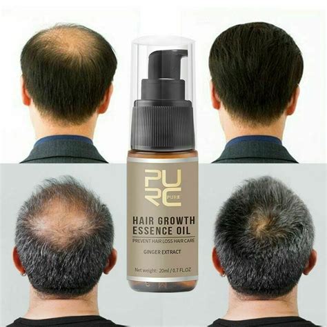 Buy Miracle Hair Growth Germinal Hair Growth Hairdressing Serum Oil Loss Treatement On Ezbuy Sg