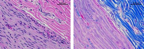 Hematoxylin And Eosin Hande Left Panel And Luxol Fast Blue Lfb Right