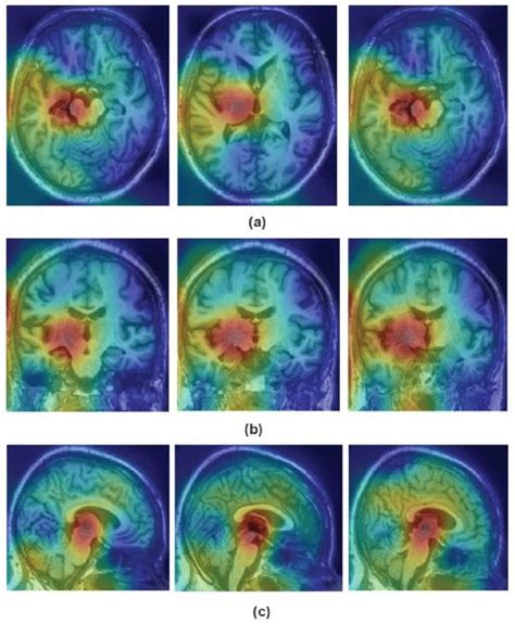 Class Activation Maps For Sample Slices Of MRI Scan That Has Been