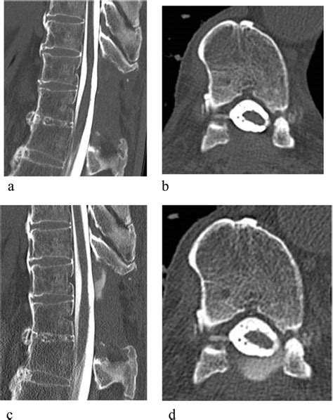 Computed Tomography Myelograms At T10 11 A Sagittal View B Axial Download Scientific