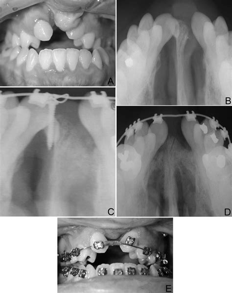 Stabilization Of Edentulous Cleft Segments For An Alveolar Bone Graft