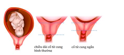 C C H Nh Nh C T Cung Khi Mang Thai Nguy Hi M C N Bi T