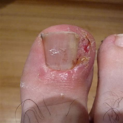 Advanced Podiatry Clinics Ingrown Toenail Treatment