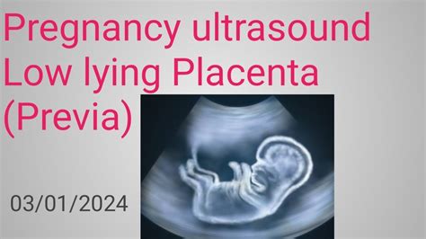 Ultrasound Showing Placenta Previa Pregnancy Ultrasound Radiology