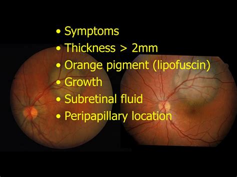 Ppt Ocular Oncology Powerpoint Presentation Free Download Id4545171