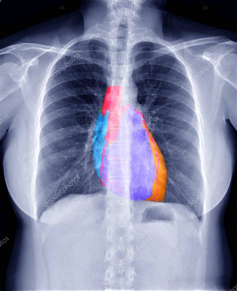 Imagen De Fusi N De La Radiograf A De T Rax Y La CTA 3D Imagen De La