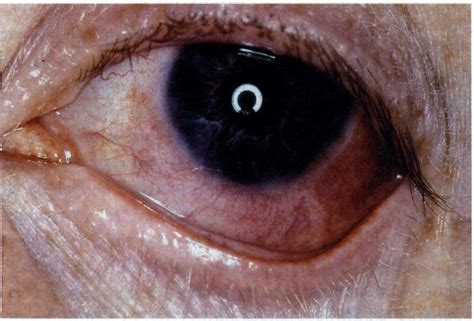 There Is Deep Injection Of The Temporal Sclera Which Does Not Blanch