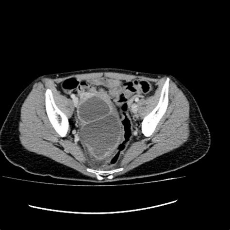 Right Tubo Ovarian Abscess Download Scientific Diagram