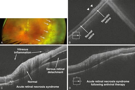 Acute Retinal Necrosis Syndrome Clinical Tree