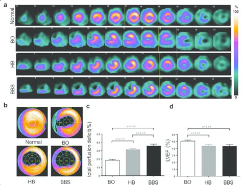 Myocardial Perfusion By Spectct Imaging A B Representative Short