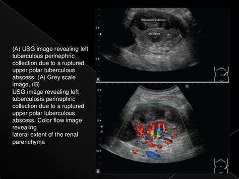 Renal tuberculosis radiology