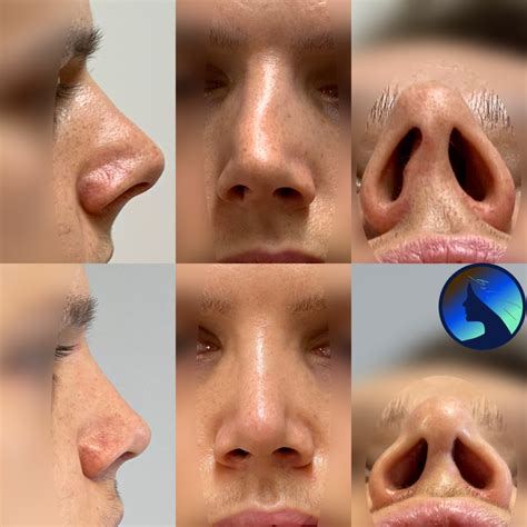 Male Rhinoplasty Dominik Boliglowa