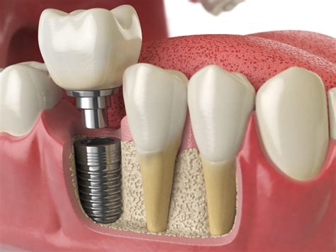 Dental Implant Process Step By Step Healing Stages Timeframe Guide