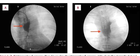 Figure 1 From A Life Threatening Mediastinal Hematoma After Central