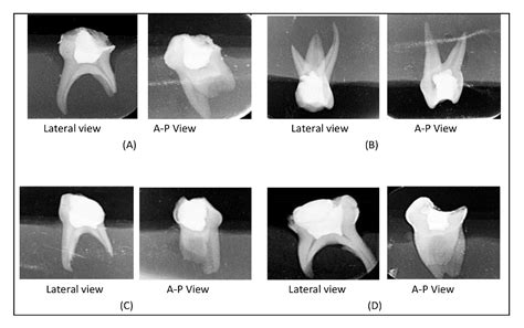 Figure 1 From Pulpal Dressing Condensation Methods In Pulpotomy For