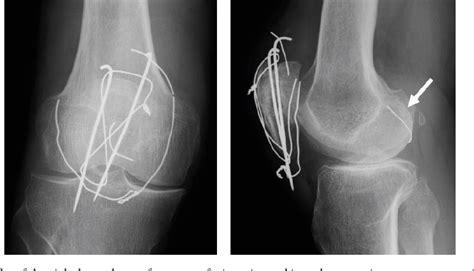 Pdf Arthroscopic Removal Of A Wire Fragment From The Posterior Septum