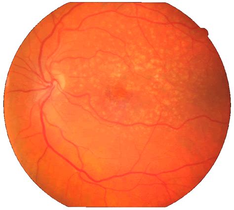 Degeneração Macular Relacionada à Idade DMRI Cornea Clinic