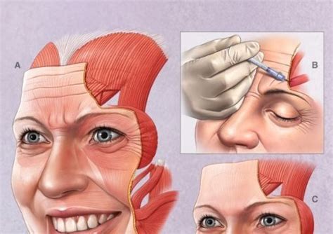 ¿cómo Funcionan Las Neurotoxinas Botox Y En Que Músculos Se Aplican