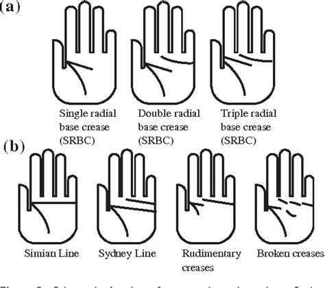 Figure 3 From Dermatoglyphics And Abnormal Palmar Flexion Creases As