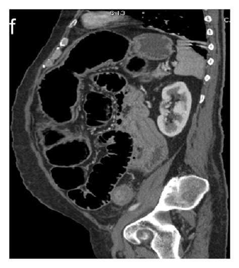 Enteroenteric Ileoileal Intussusception Secondary To Colic Download Scientific Diagram