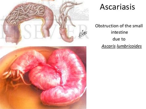 Pathopyshiology Of Intestinal Obstruction Chirantan Mandal Medical Co