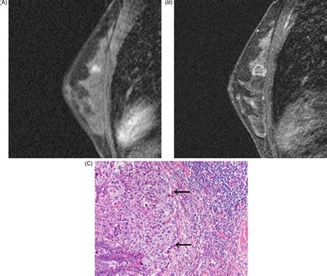 Mr Imaging Of Medullary Carcinoma Of The Breast European Journal Of