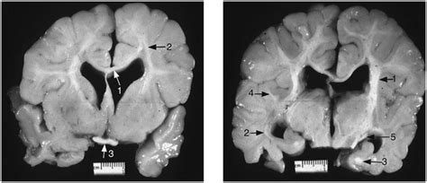 Phenylketonuria Brain