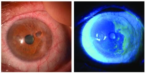 A Case Of Limbal Stem Cell Deficiency Lscd In A Patient With Chronic