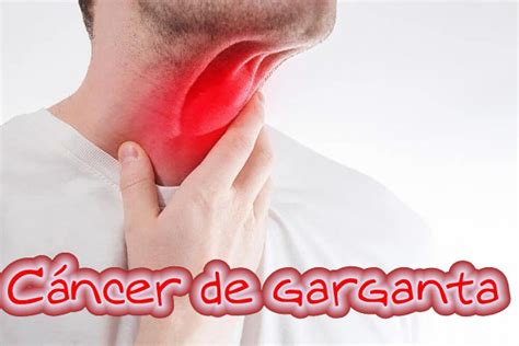 Cáncer de garganta - Clinica Hispana Woodforest