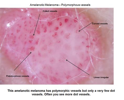 Dermoscopy Made Simple Melanoma In Situ Mainly