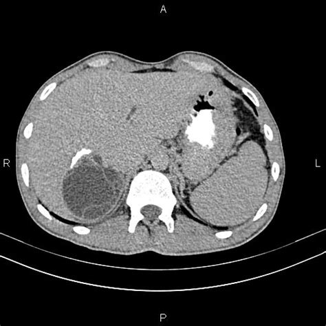 Intrabiliary Rupture Of Hepatic Hydatid Cyst Image