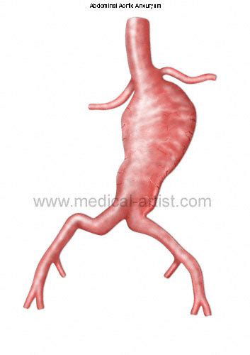 Aortic Aneurysm Medical Illustrations Of Surgical Technique To Repair An Aortic Aneurysm