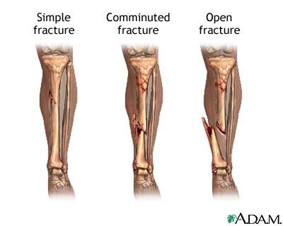 Fracture, comminuted. Causes, symptoms, treatment Fracture, comminuted