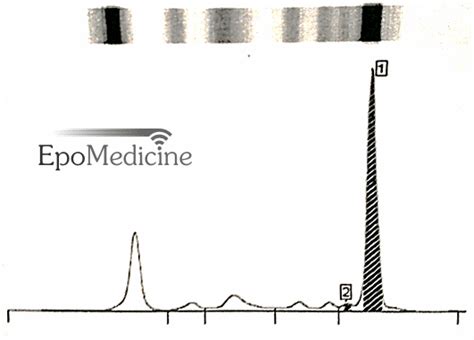 M-spike | Epomedicine