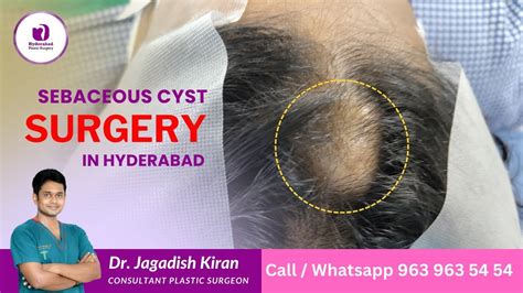 Sebaceous Cyst Treatment Best Cyst Removal In Hyderabad Sebaceous Surgery In Hyderabad Cyst