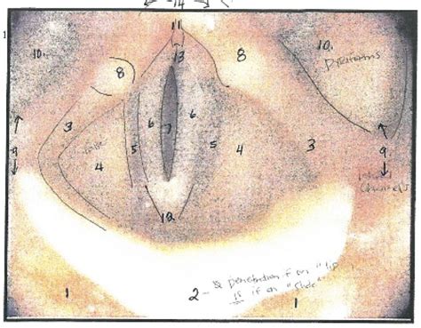 Dysphagia Quiz 3 Diagram Quizlet