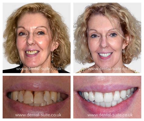 How Much Is A Full Set Of Dental Implants Cost Dental News Network