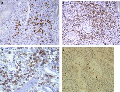 Characterization Of Infiltrating Cells By Immunohistochemistry The