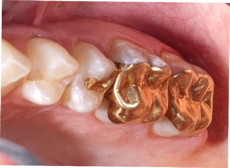 Gold Inlays Gold Onlays And Gold Crowns Portland Or Haven Dental Pdx