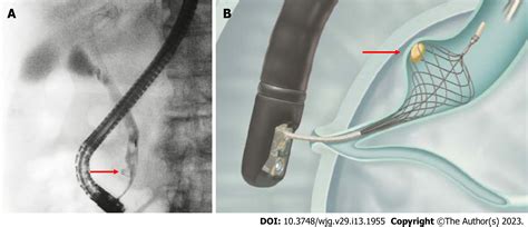 Comprehensive Review On Small Common Bile Duct Stones