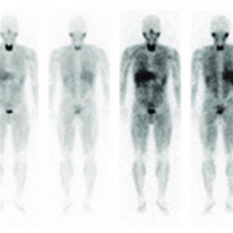 I Metaiodobenzylguanidine Mibg Scintigraphy Of The Patient From