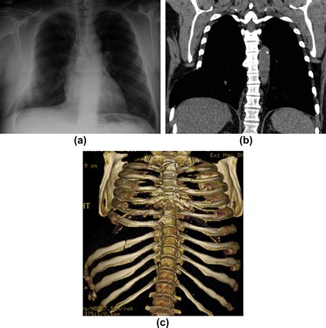 Intercostal Lung Hernia Radiographic And MDCT Findings Clinical