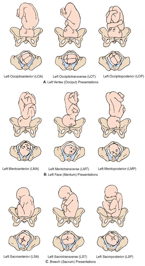 NURSEupdate: LEFT FETAL PRESENTATIONS