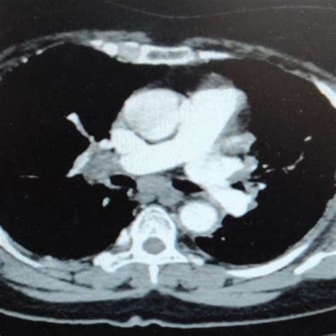 Computed Tomographic Image Of The Chest Demonstrating Hilar And Download Scientific Diagram