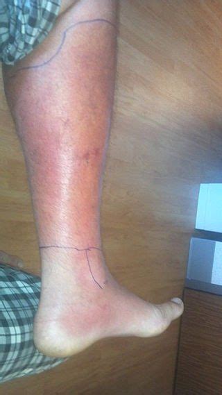 Cellulitis Foot