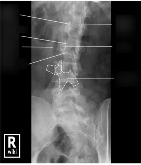 Ap Oblique Lumbar Spine X Ray Anatomy Demonstration Diagram Quizlet